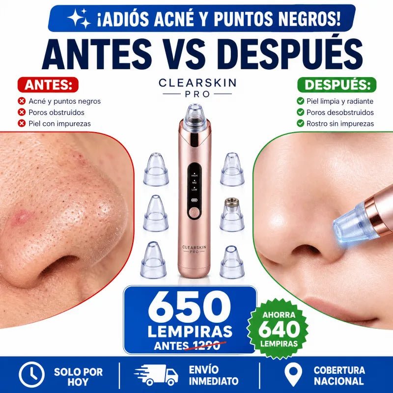 ClearSkin Pro™ – Limpiador Facial de Puntos Negros con Succión Eléctrica